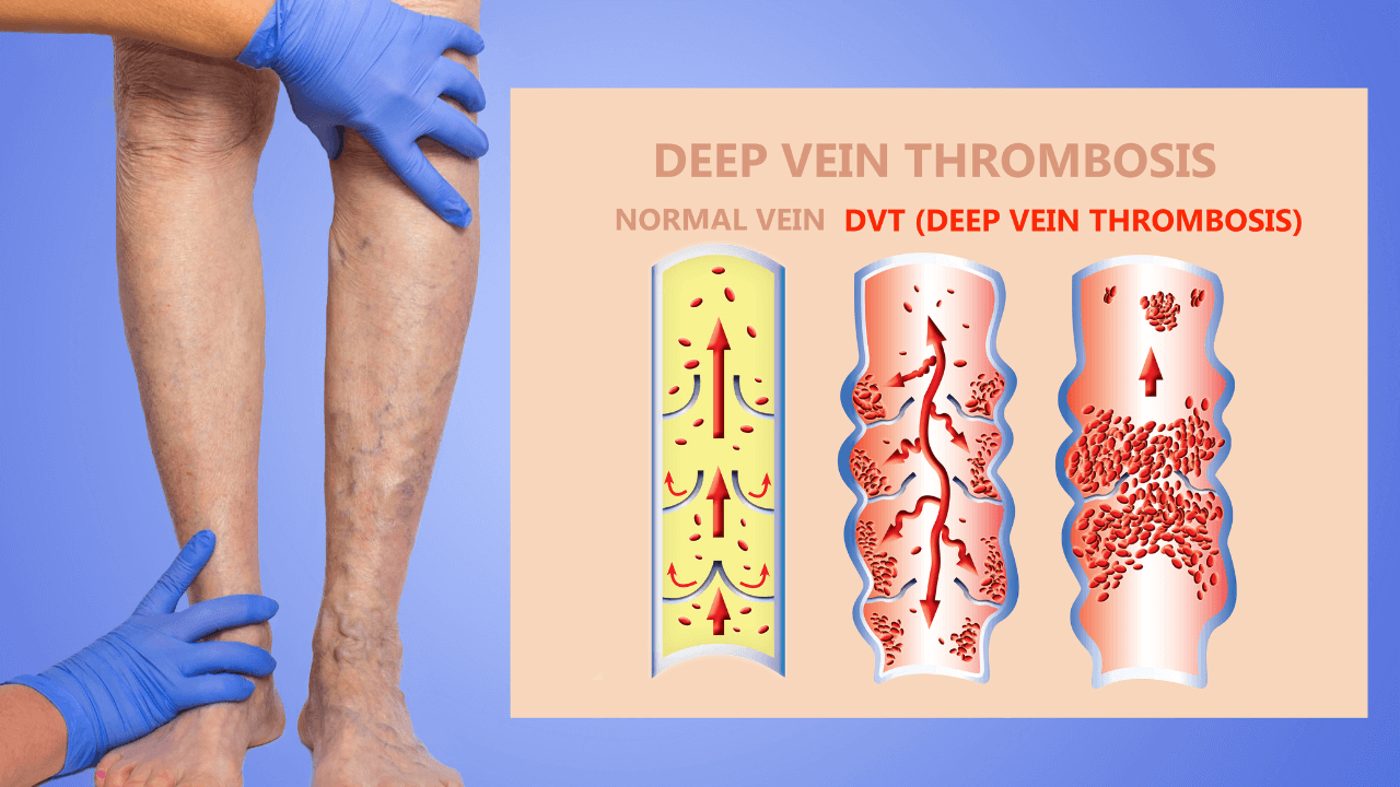 What Causes Blood Clots In Legs Deep Vein Thrombosis